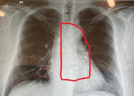 Chest X-Ray Edited.jpg